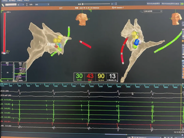 撥開異常心電圖的層層迷霧