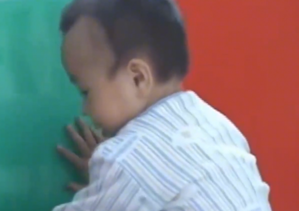 真實故事：陝西1歲幼童患怪病，身體長出鐵釘，醫生查明真相