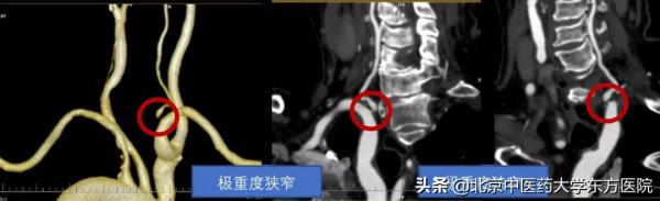 【醫學小常識】有一種眩暈需要格外注意