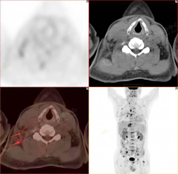 肺結節看診（13）：肺小結節全身廣泛轉移2例，PET分期：晚期