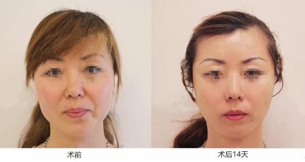 「案例分析」49歲的李女士，PSV面部提升後，脖子怎麼也變長了？