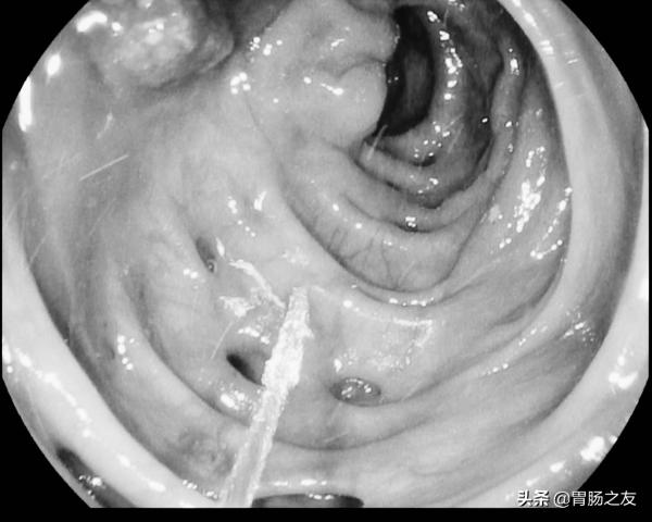 女老師反覆腹痛、便秘兩年,差點開腹切腸子,一查腸鏡原因找到了 女老師反覆腹痛、便秘兩年,差點開腹切腸子,一查腸鏡原因找到了