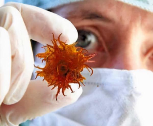 奪走趙忠祥生命的鱗狀細胞癌,聽起來陌生,實際上卻很常見 奪走趙忠祥生命的鱗狀細胞癌,聽起來陌生,實際上卻很常見