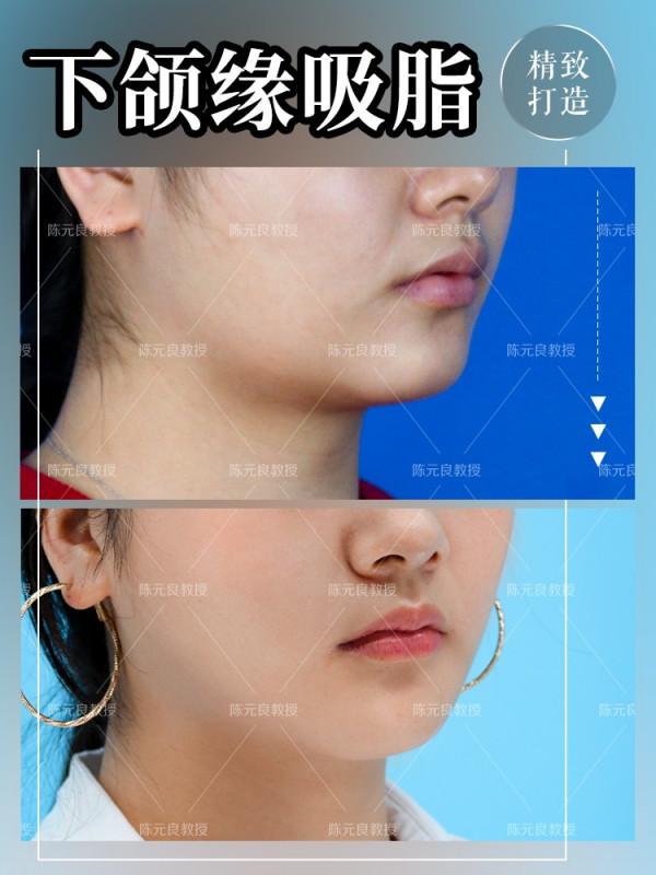 面部吸脂你真的都瞭解嗎？來看看面部吸脂的常見問題解答