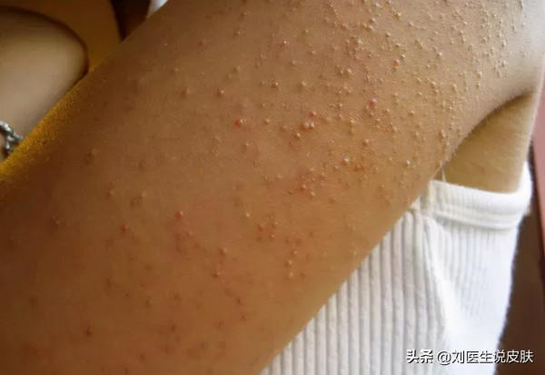 別人的面板光滑細膩，你的面板“雞皮”密密？這份自救指南請收好