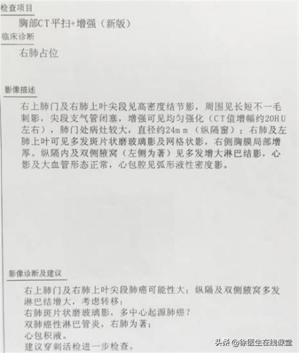 35歲女子雙腳水腫,診斷腎病綜合徵,出現咳嗽時醫生才發現是肺癌 35歲女子雙腳水腫,診斷腎病綜合徵,出現咳嗽時醫生才發現是肺癌