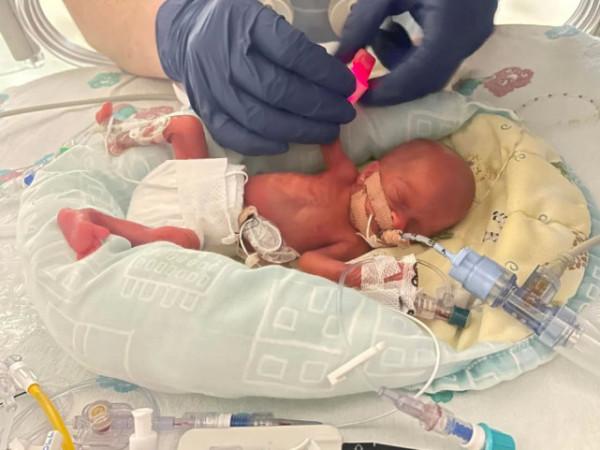 英國最小寶寶出生，體重6兩，媽媽孕25周生下，6周後長到1斤