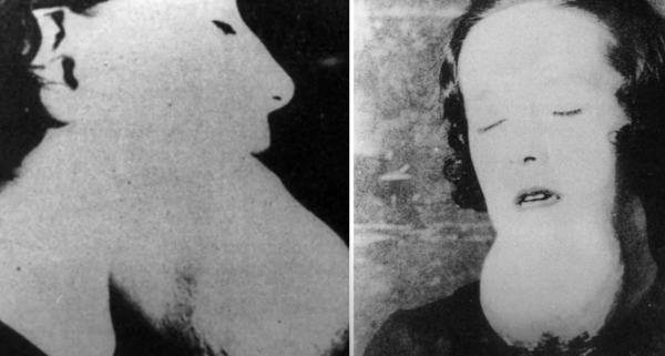 牙齒爛光,臉長巨瘤,骨頭還會發光,被美國資本家逼向絕路的女工 牙齒爛光,臉長巨瘤,骨頭還會發光,被美國資本家逼向絕路的女工