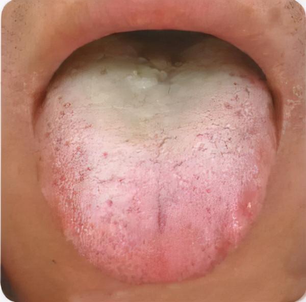 痰溼百病生！為什麼說結節與&OpenCurlyDoubleQuote;痰溼&rdquo;有關，老中醫講述結節的本質