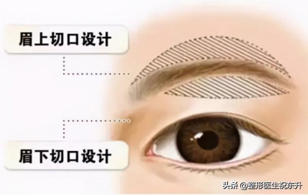 提眉術後會留疤嗎?間隔1米的距離,別人看不見 提眉術後會留疤嗎?間隔1米的距離,別人看不見