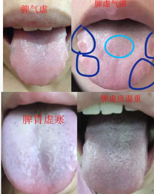 喝粥能改善脾虛嗎？脾虛如何快速改善？