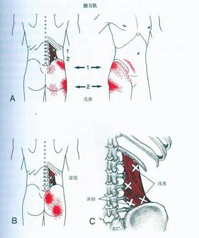 肌源性腰痛之腰方肌淺析 肌源性腰痛之腰方肌淺析
