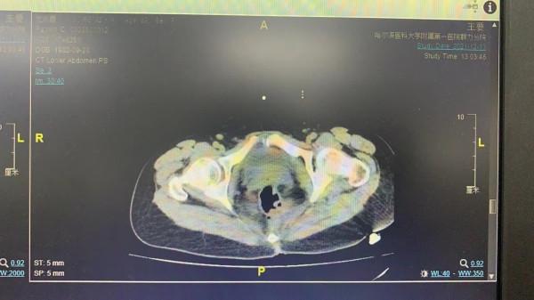 哈醫大一院群力婦科成功治癒一例罕見盆腹腔多部位增生性組織細胞病