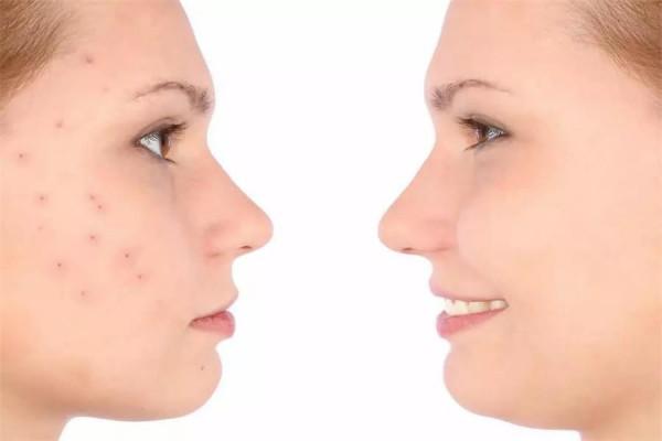 痘痘反覆不見好?可能是2件事沒做好,想要祛痘,3個習慣很重要 痘痘反覆不見好?可能是2件事沒做好,想要祛痘,3個習慣很重要