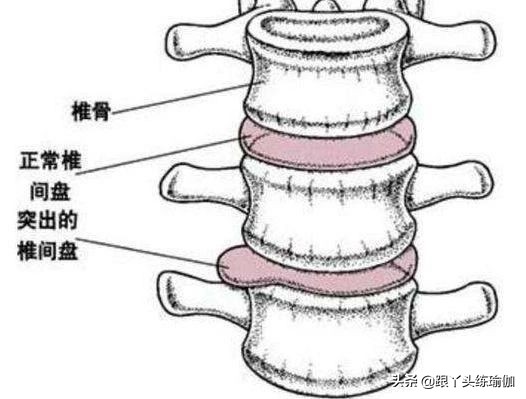 困擾2億人的腰椎間盤問題，並不是老年病，六成都是年輕人