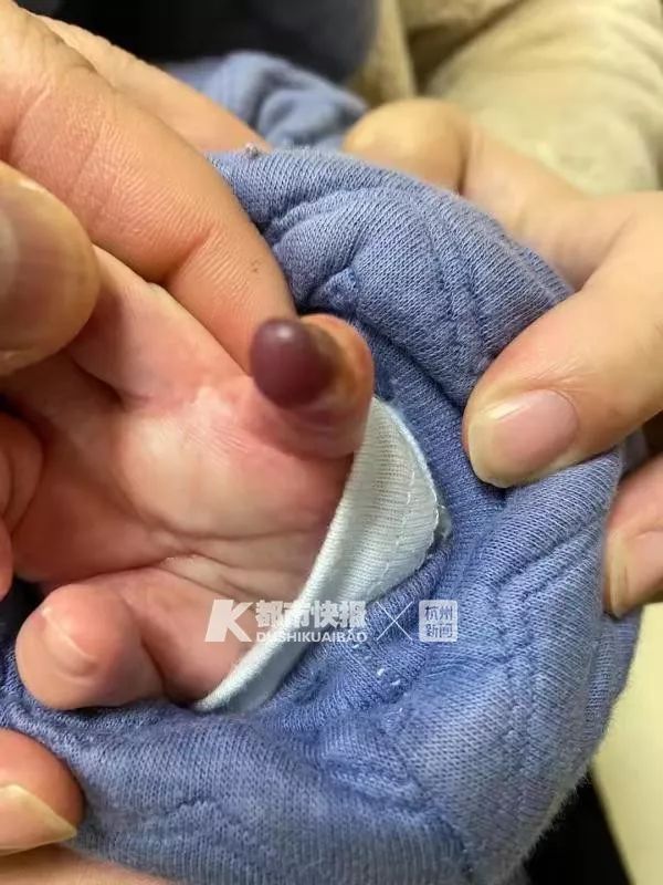 只因寶媽一個疏忽，新生1天嬰兒差點截肢！爸媽注意，一根頭髮絲都可能導致意外