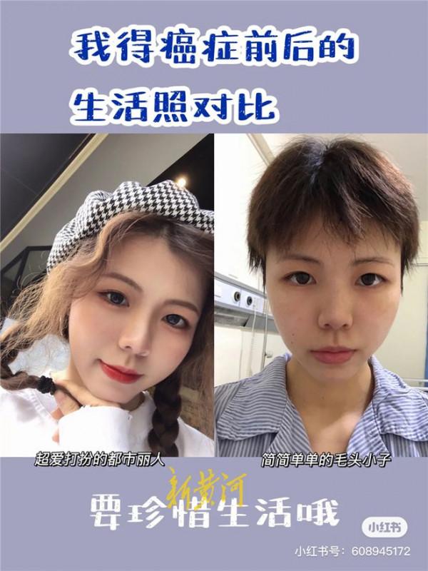 24歲女生抗癌一年：做3次化療30多次放療 脖子潰爛