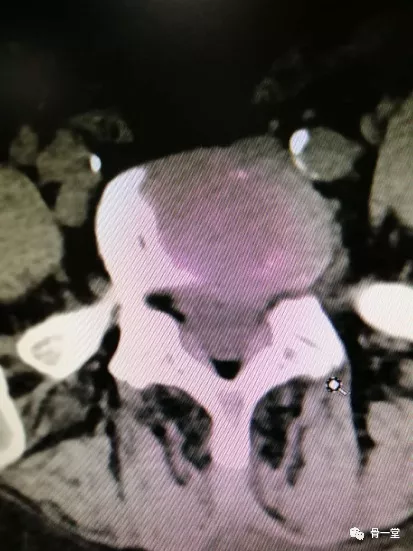 真正的脊柱微創-misTLIF入路經脊柱內鏡下椎管減壓融合治療