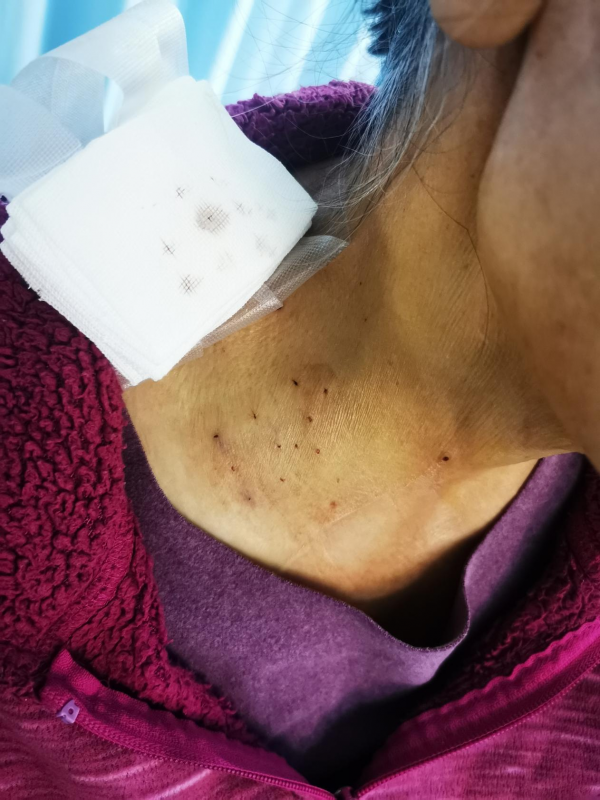 廣西首例！惡性腫瘤患者的福音