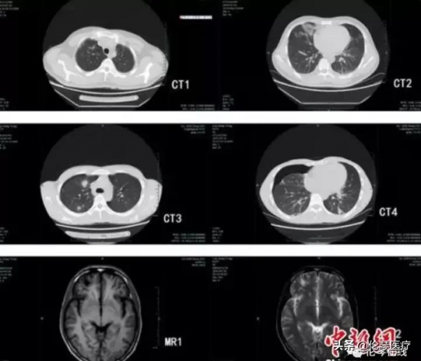 這種吃螃蟹吃出的怪病,影像醫生都是怎麼診斷的?|倫琴醫療 這種吃螃蟹吃出的怪病,影像醫生都是怎麼診斷的?|倫琴醫療