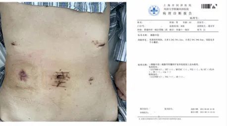 同濟大學附屬同濟醫院普通外科完成全腔鏡下中段胰腺腫瘤切除術