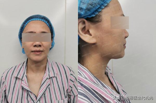 微創小切口面部提升+面部脂肪,朋友說術後看著能年輕上至少10歲 微創小切口面部提升+面部脂肪,朋友說術後看著能年輕上至少10歲