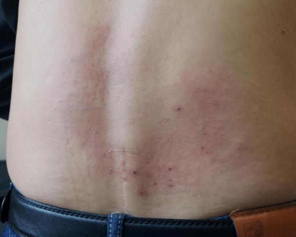 天熱復發,只發生於軀幹的丘疹紅斑性面板病 天熱復發,只發生於軀幹的丘疹紅斑性面板病