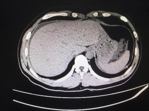 又是熟人惹的禍,急性出血性胰腺炎 又是熟人惹的禍,急性出血性胰腺炎