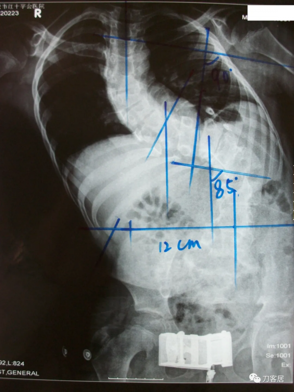惡性高熱第3例：12歲，脊柱側彎，矯形術後死亡