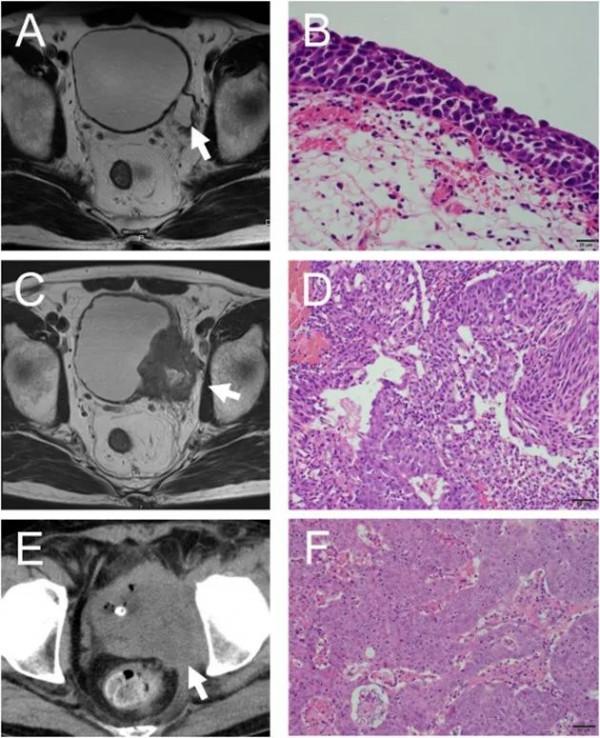免疫治療療效長達2年多，化療後PD-L1表達水平或預測療效 &vert; 膀胱癌實踐病例