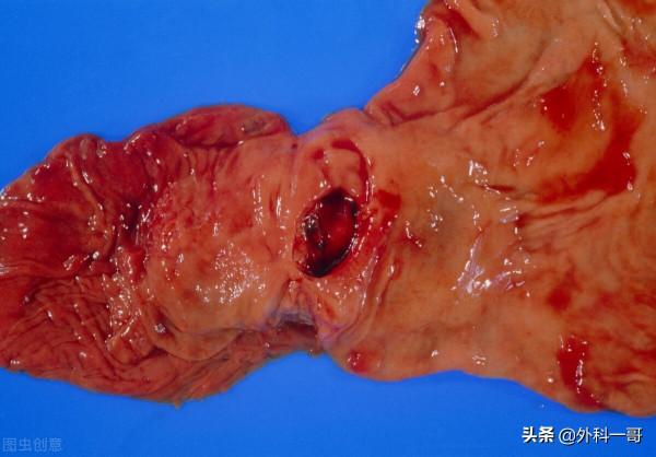 手術與肥胖以及那些貪吃教皇的下場