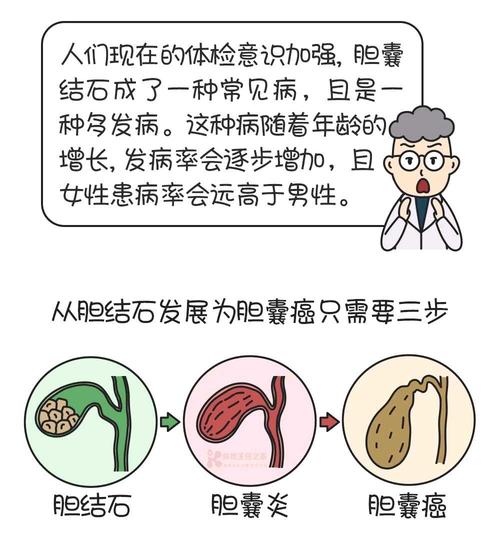 膽囊結石一定要摘除膽囊嗎？摘除了居然還有復發的風險，一文說清