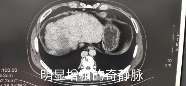 不明原因的下肢靜脈曲張、潰瘍及色素沉著——警惕布加綜合徵可能