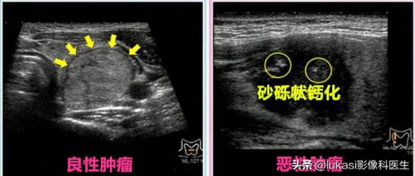 什麼是甲狀腺癌？看看專家是怎麼說的