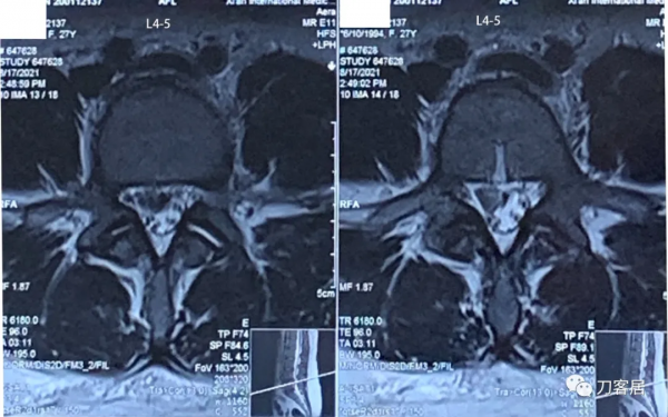 27歲女性，兩間隙腰椎間盤突出症，6顆釘子，4個融合器