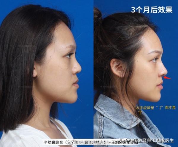 鼻基底填充後,為什麼會變成“猴子”?原來是裡沒有處理好 鼻基底填充後,為什麼會變成“猴子”?原來是裡沒有處理好