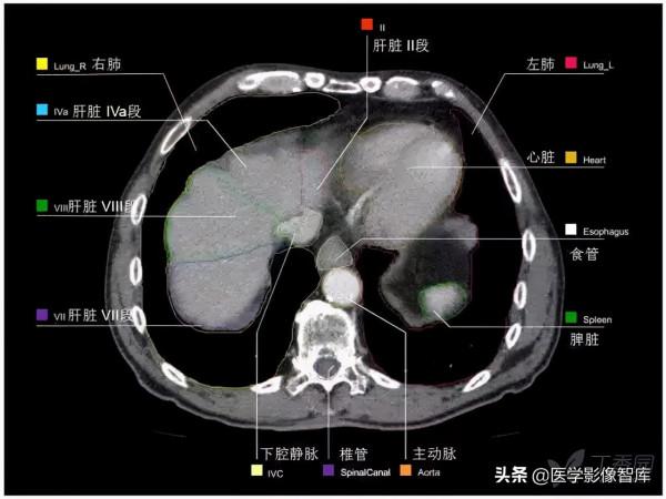 CT斷層解剖圖譜最全總結「推薦收藏」 CT斷層解剖圖譜最全總結「推薦收藏」