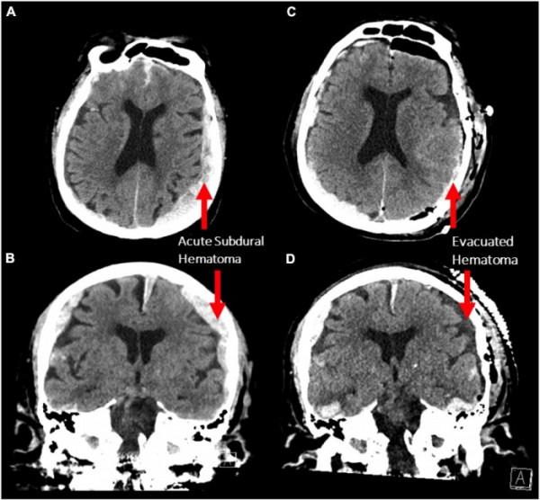 科學家首次記錄瀕臨死亡的人類大腦的活動 揭示類似夢境的活動