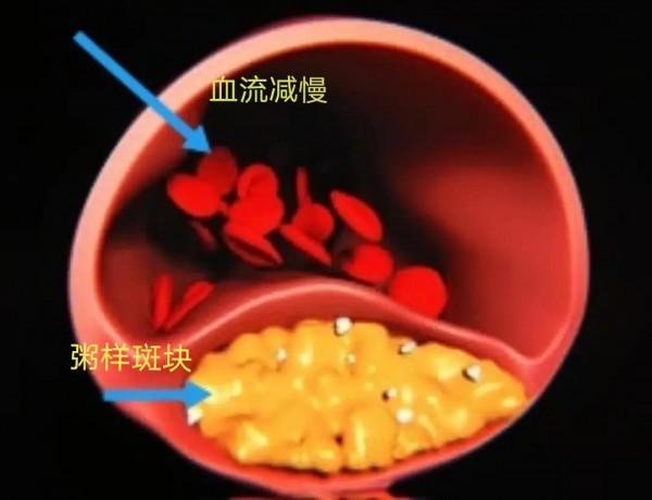 頸動脈硬化斑塊是如何形成的,吃什麼藥可以治癒?醫生為您講清楚 頸動脈硬化斑塊是如何形成的,吃什麼藥可以治癒?醫生為您講清楚