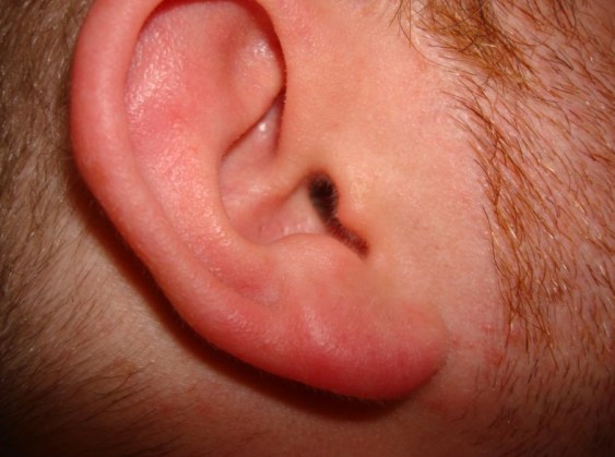 老人突發耳鳴莫大意,警惕是心梗先兆 老人突發耳鳴莫大意,警惕是心梗先兆