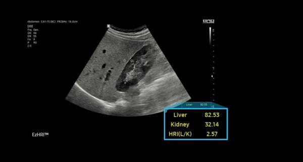 三星醫療高階超聲診斷系統&mdash;&mdash;RS85 Prestige