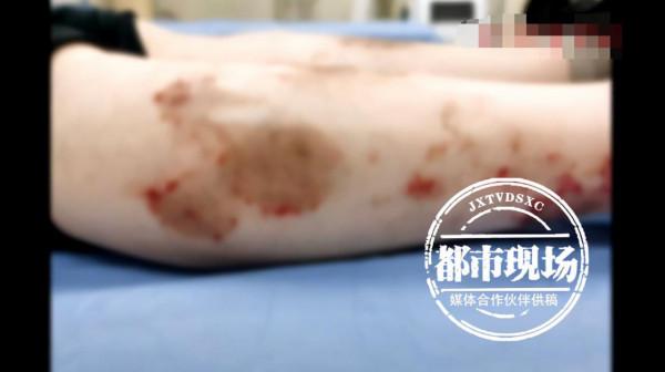 有沒有搞錯?治了2年的“面板病”,竟然是腫瘤 有沒有搞錯?治了2年的“面板病”,竟然是腫瘤