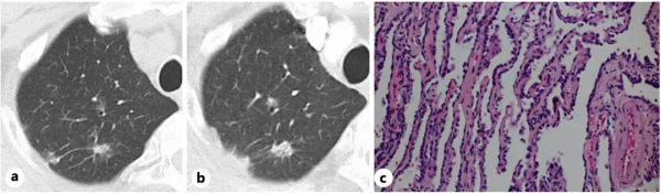 消失的病灶，奧希替尼單藥治療晚期肺癌達到病理完全緩解
