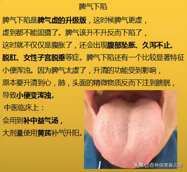 脾氣虛、脾陽虛,這6種脾虛,從初級到嚴重,你是屬於哪一種? 脾氣虛、脾陽虛,這6種脾虛,從初級到嚴重,你是屬於哪一種?