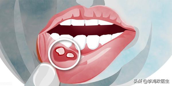 男子腹痛,以為闌尾炎,直到出現口腔潰瘍才發現闌尾切錯了 男子腹痛,以為闌尾炎,直到出現口腔潰瘍才發現闌尾切錯了