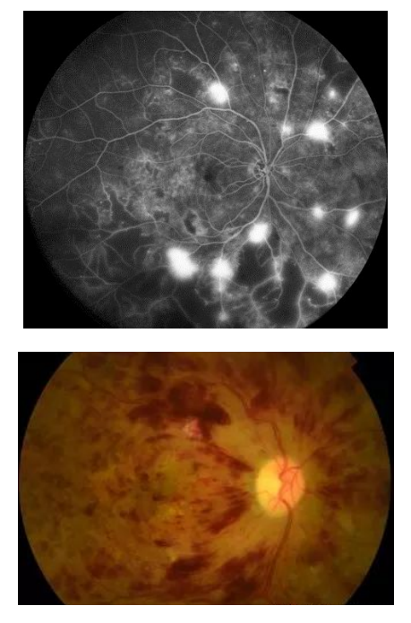 眼睛長“黃斑”別大意！延誤治療時機當心失明
