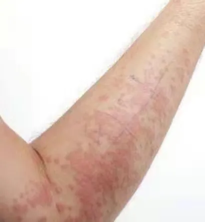 ​劇烈瘙癢，反覆發作，會不會是溼疹？