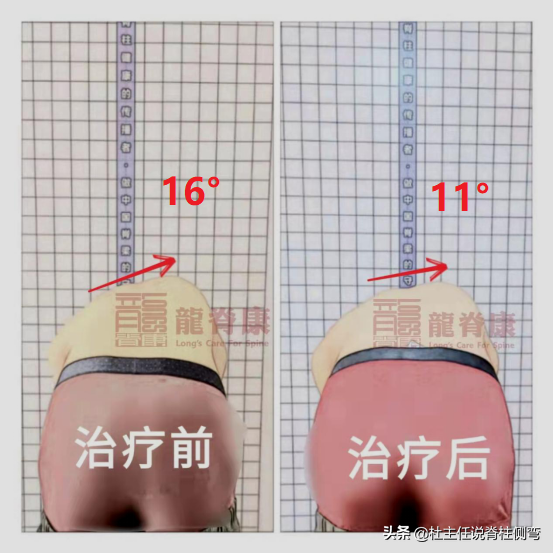 成人脊柱側彎堅持3天強化班訓練，剃刀背減少5°