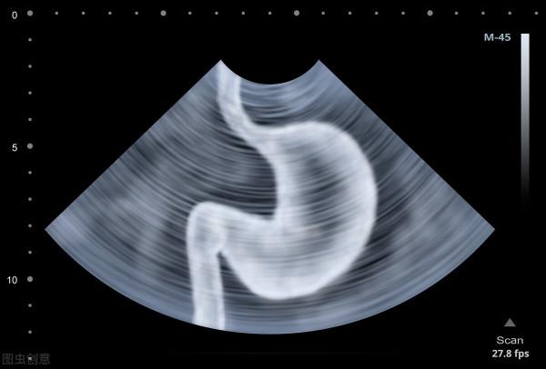 糖友注意，出現早飽、腹脹、噁心等不適，很有可能是胃輕癱在作怪