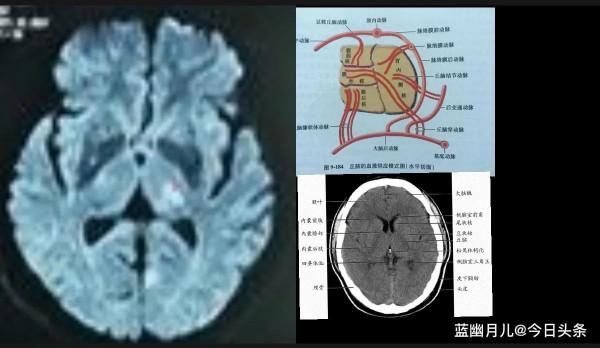 腔隙性腦梗死的診療常規